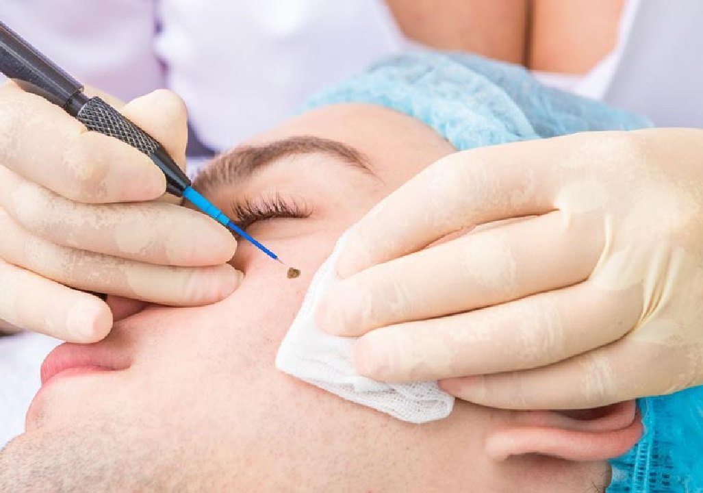 Mole Skin Tag Removal Treatment in pune